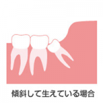 親知らずの抜歯