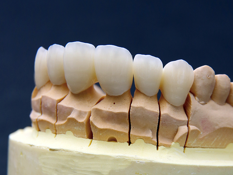 ジルコニア・セラミッククラウン
