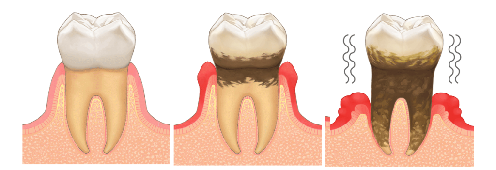 歯周病の進行イメージ