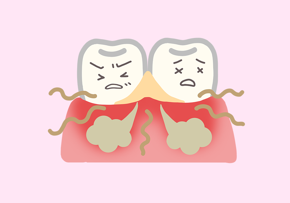 「歯肉炎」「歯周炎」「歯周病」「歯槽膿漏」